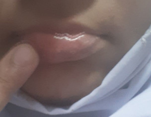 Lip Swelling