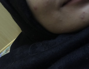 Hormonal Acne Or Activeacne 