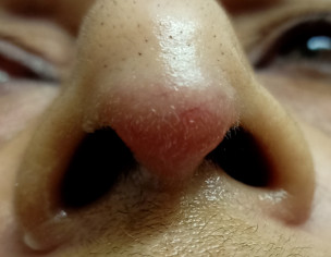 Nose Tip Redness And Swelling 
