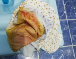 Mucus And Blood In Stool