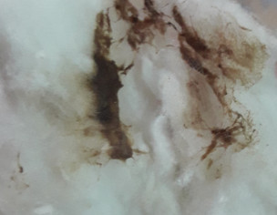 Brown Color Discharge Spotting