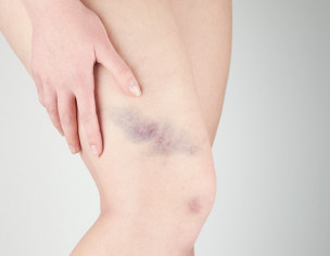 Skin Bruises