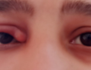 Eye Infection