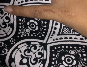 Burn Mark From Cloth Iron On Finger