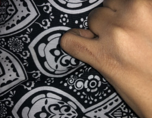 Burn Mark From Cloth Iron On Finger