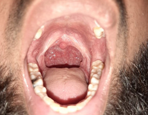 Throat Problem After Removal 