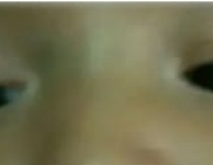 White Patches On 06 Months Baby Face 