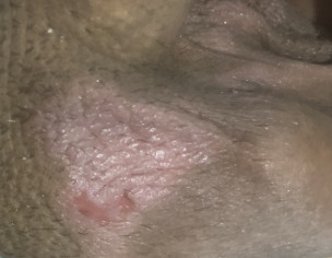 Scrotal Itching With Pink Patches