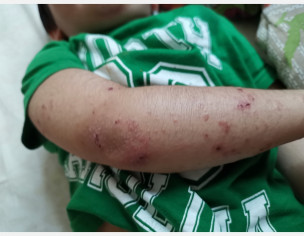 Atopic Dermatitis Ezcema 