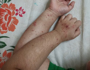 Atopic Dermatitis Ezcema 