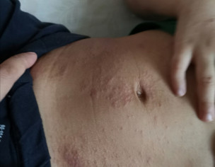 Atopic Dermatitis Ezcema 