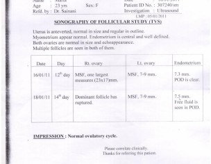 Unexplained Infertility 