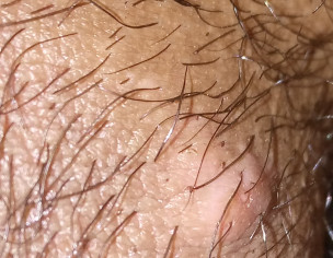 Bump On My Penis And Balls 