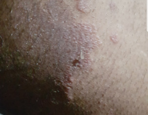 Rashes/Infection Near Penis