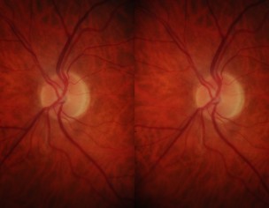 Glaucoma...Please Help Ophthalmologist