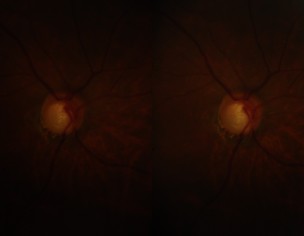 Glaucoma...Please Help Ophthalmologist