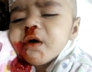 Heavy Oral And Nasal Bleeding