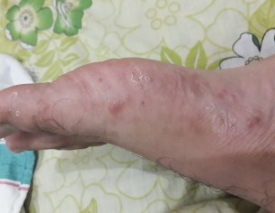 Dyshidrotic Eczema