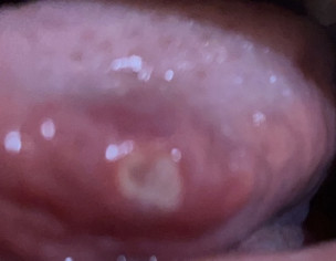 Mouth Ulcers.