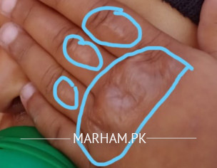 Hand Burn Due To Electric Iron