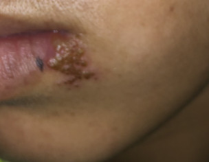Wound Type Thing On Lips 