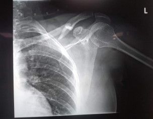 Fracture In Clavicle