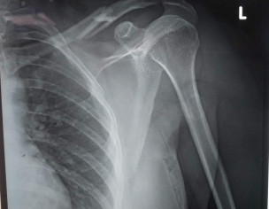 Fracture In Clavicle
