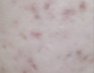 Acne Marks And Scars