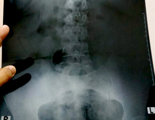 Pain In Lower Back And Hip