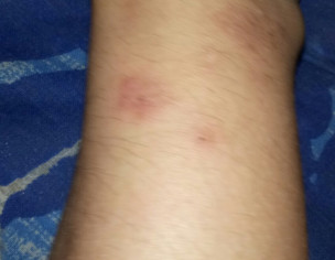 Eczema, Allergy Itching