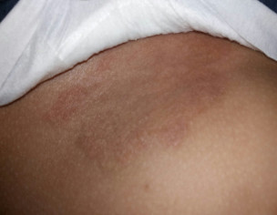 Eczema, Allergy Itching