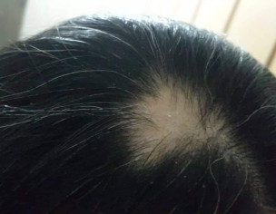 Baldness During Pregnancy 
