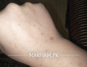 Dark Spots On Hands