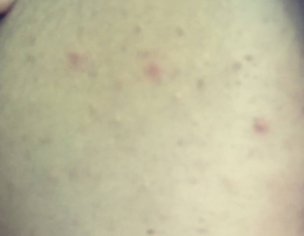 Acne, Weight Gain, Self Induced Vomiting