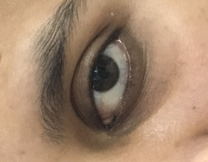 Eye Problem (blindness)