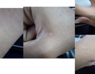 Bumps On My Penis And Balls 