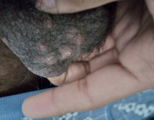 Bumps On My Penis And Balls 