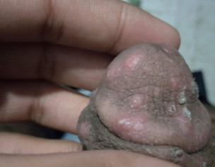 Bumps On My Penis And Balls 