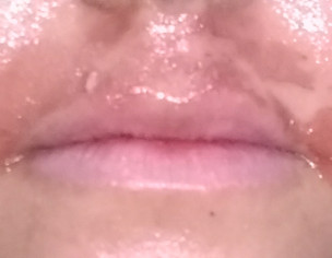 Skin Burnt/ripped Off