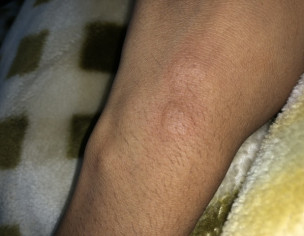 Accident, How To Prevent Mark Or Scar 