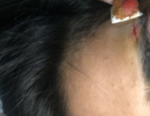 Accident, How To Prevent Mark Or Scar 