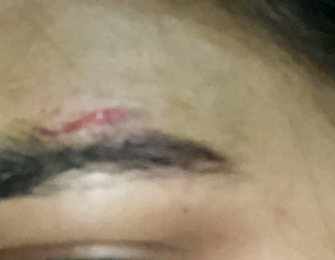 Accident, Swelling And How To Avoid Scar Or Mark 