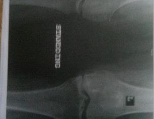 Swelling ,pain And Redness In One Foot