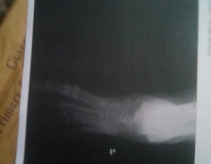 Swelling ,pain And Redness In One Foot