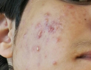 Severe Acne 
