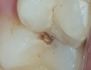 Tooth Cavity 