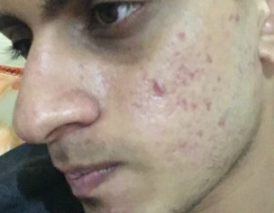 Got Acne From The Past 2 Months 