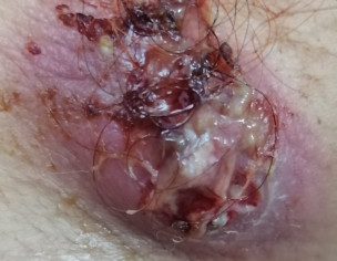 Exploded Lymph Node