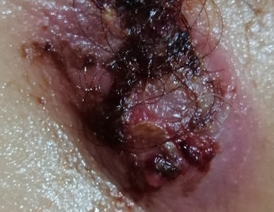 Exploded Lymph Node
