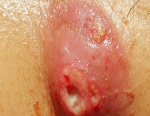 Exploded Lymph Node